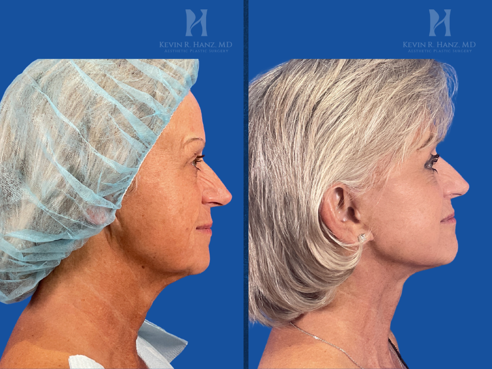 Deep Plane Facelift Before and after photos of a female patient who received a Deep Plane Facelift, eyelid surgery, fat grafting, and CO2 laser resurfacing at Kevin R. Hanz, MD Aesthetic Plastic Surgery. The image shows significant facial rejuvenation, smoother skin texture, and a more youthful appearance.