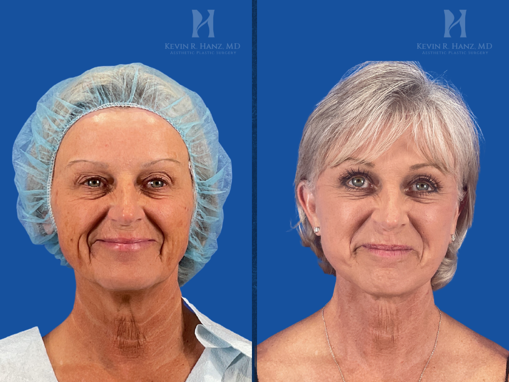 Deep Plane Facelift Before and after photos of a female patient who received a Deep Plane Facelift, eyelid surgery, fat grafting, and CO2 laser resurfacing at Kevin R. Hanz, MD Aesthetic Plastic Surgery. The image shows significant facial rejuvenation, smoother skin texture, and a more youthful appearance.