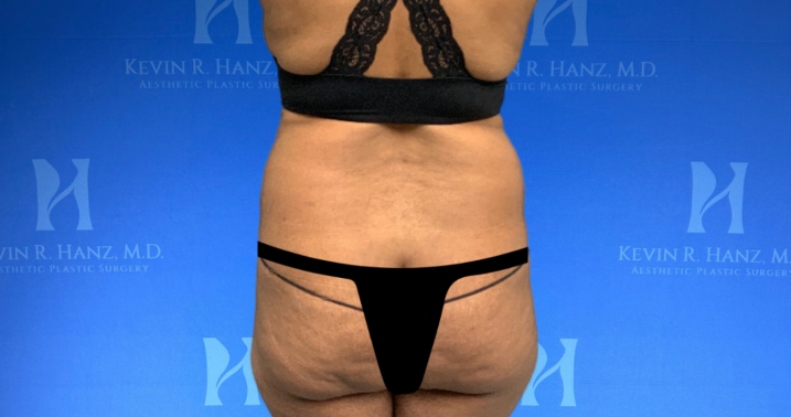 Back side view of a woman before Liposuction in Dallas, TX