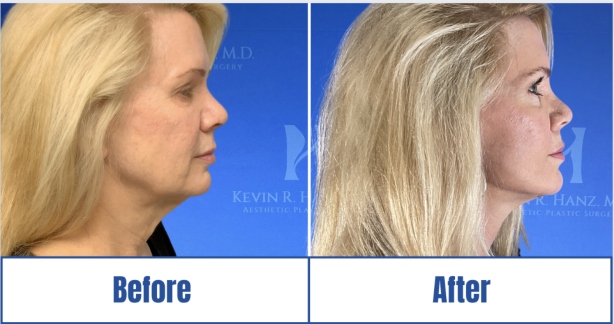 Face Lift Surgery side view before and after results of a woman in Dallas, TX