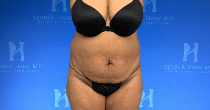 Front view of a woman after liposuction in Dallas, TX