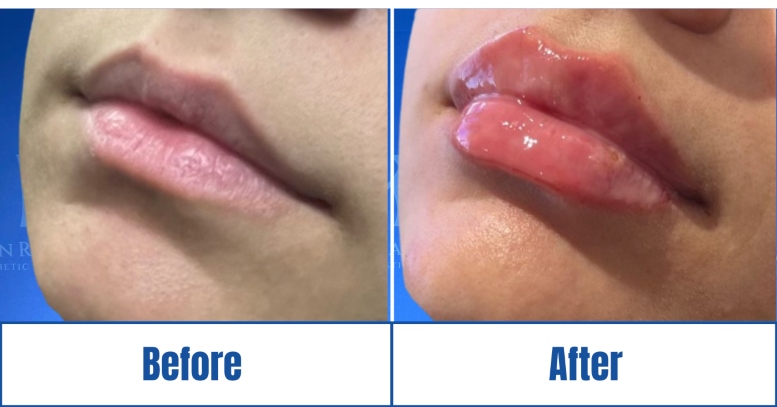 Lip Filler before and after results of a woman in Dallas, TX