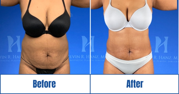 Liposuction before and after results of a woman in Dallas, TX