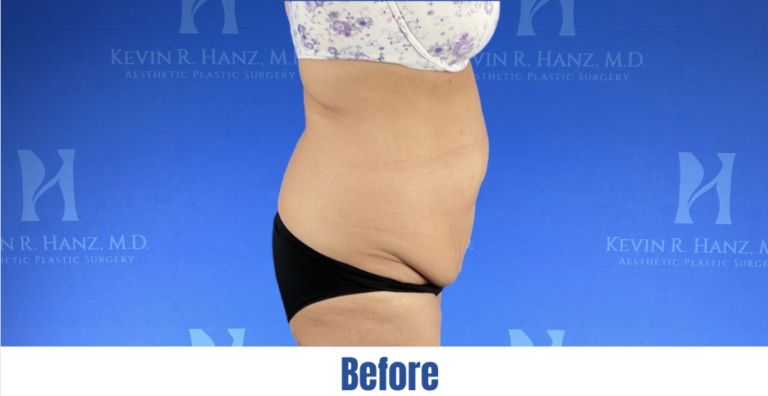 Side view of a woman before abdominoplasty in Dallas, TX