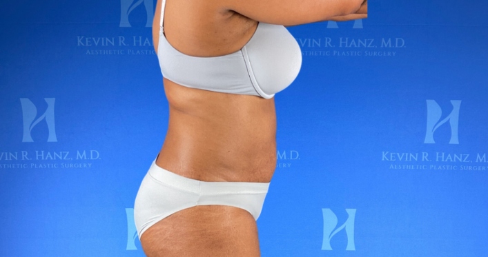 Side view of a woman after liposuction in Dallas, TX