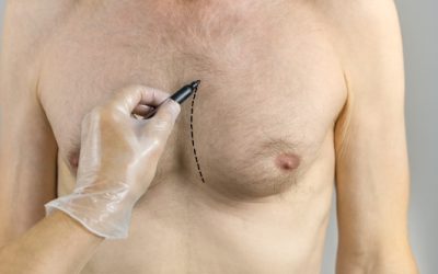 Male Gynecomastia Treatment Options